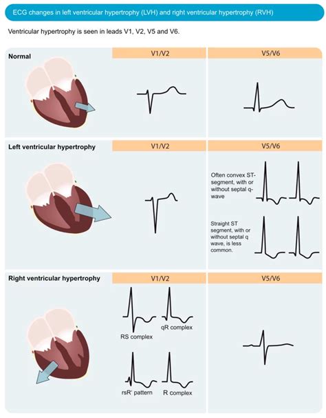 normal ekg vs lvh.